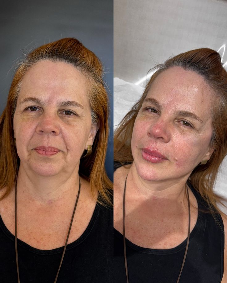 Resultados antes y después del uso del serum facial antiarrugas premium en piel madura.