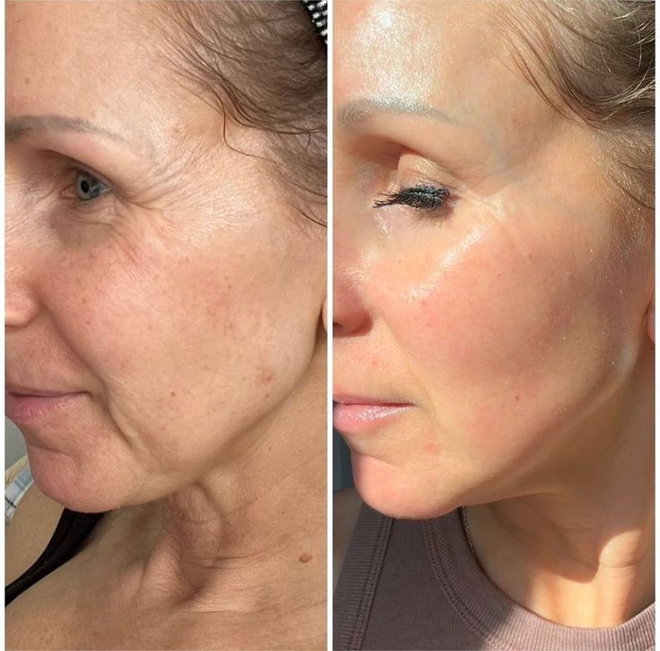 Antes y después del uso del serum facial antiarrugas premium mostrando la reducción de arrugas y una piel más luminosa.